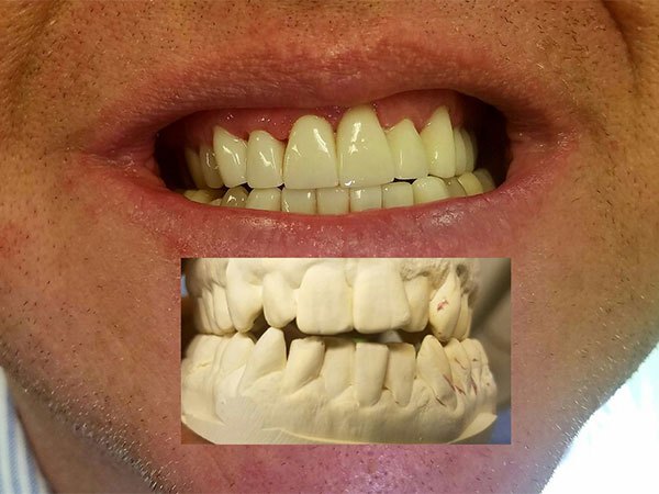 Before and After a dental procedure from William Penn Dentistry